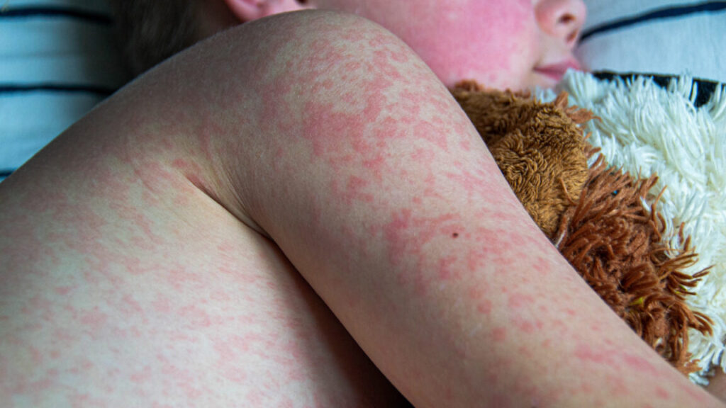 measles outbreak analysis